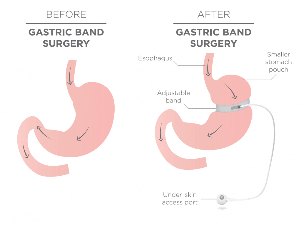 Gastric band before and after