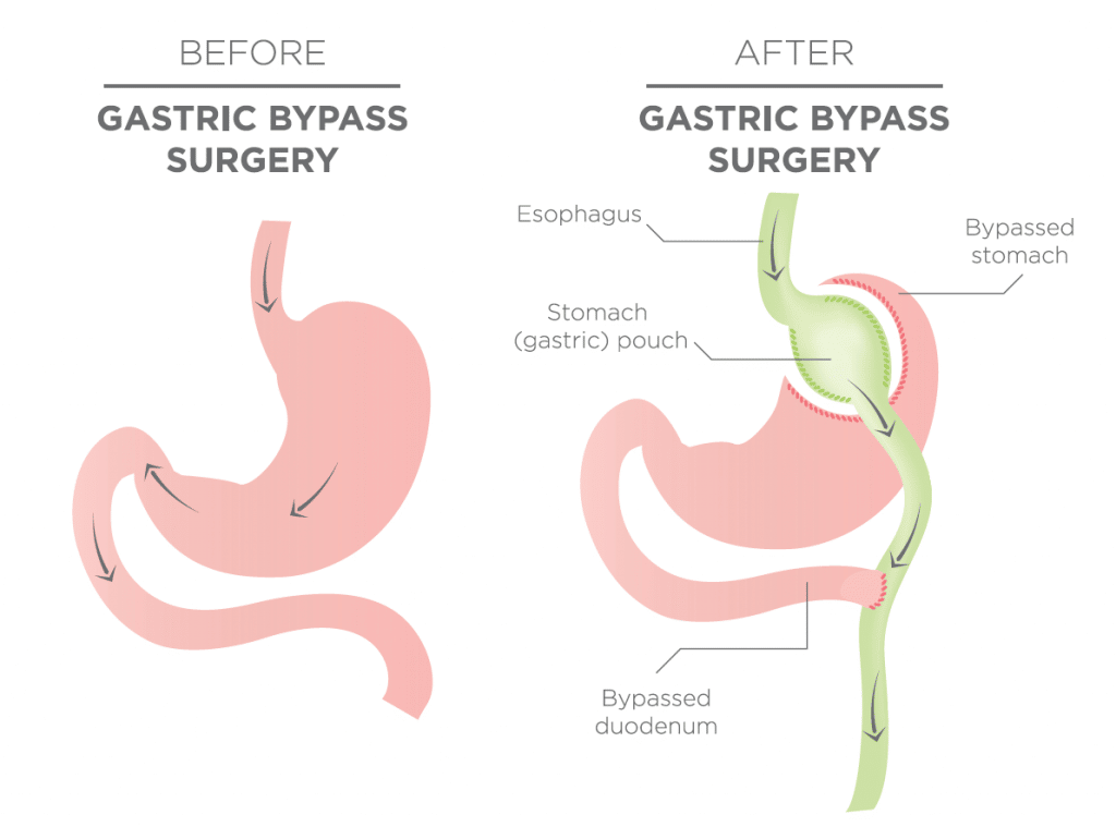 Gastric Bypass before and after