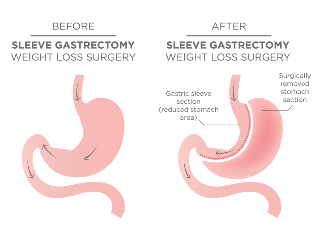 Sleeve gastrectomy before and after
